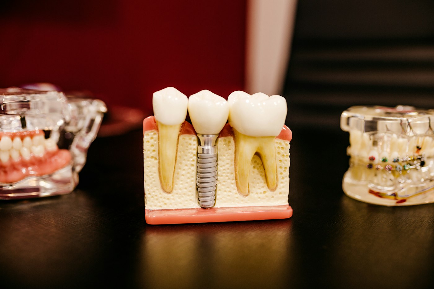 Cấy ghép răng Implant